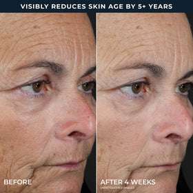 RoC Retinol Correxion Peel Pads in use on skin