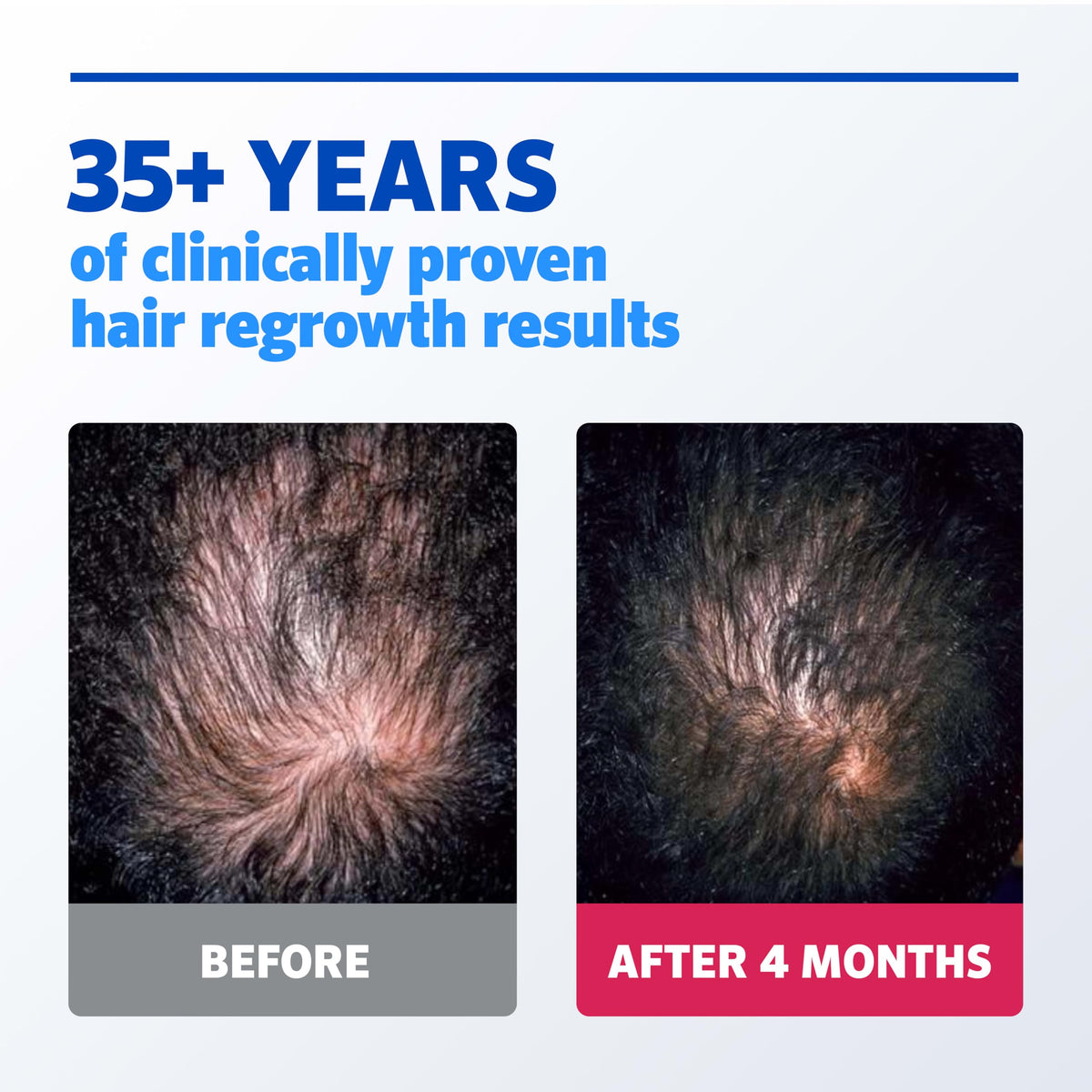 Rogaine Minoxidil Solution with hydrating glycerin ingredients