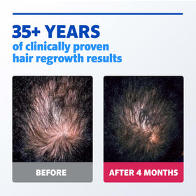 Rogaine Minoxidil Solution with hydrating glycerin ingredients