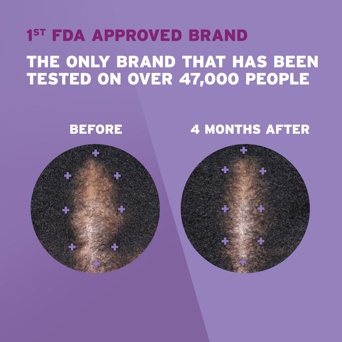 Rogaine Women's 5% Minoxidil Foam application on scalp