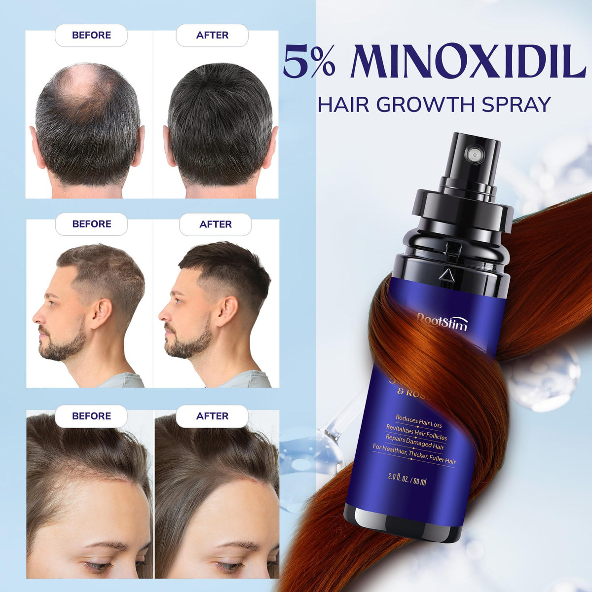 RootStim Hair Growth Spray 5% Minoxidil with rosemary extract