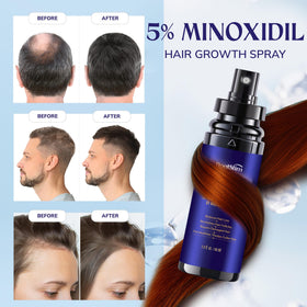 RootStim Hair Growth Spray 5% Minoxidil with rosemary extract