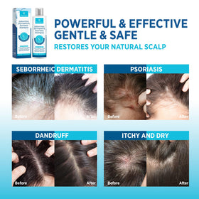 Roycederm Seborrheic Dermatitis Face Cream in bathroom setting