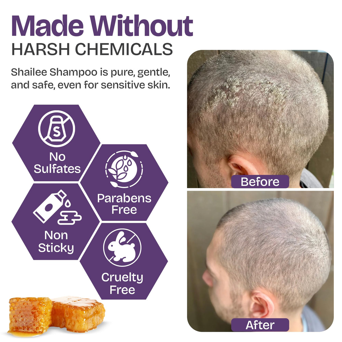 Shailee Psoriasis Shampoo 240g side view with product label