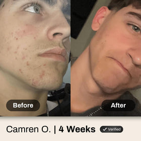 Shield Face Acne Wash for Men showing application on hands