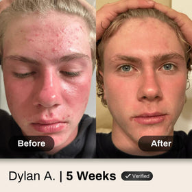 Shield Face Acne Wash for Men with a towel and skincare routine