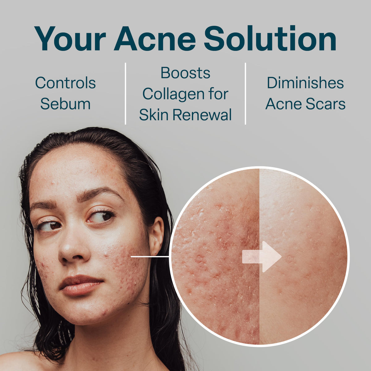 Side view of QRxLabs Acne Clearing Pads packaging