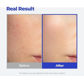 SKINSINS Acne Cream 14g open jar showing cream texture