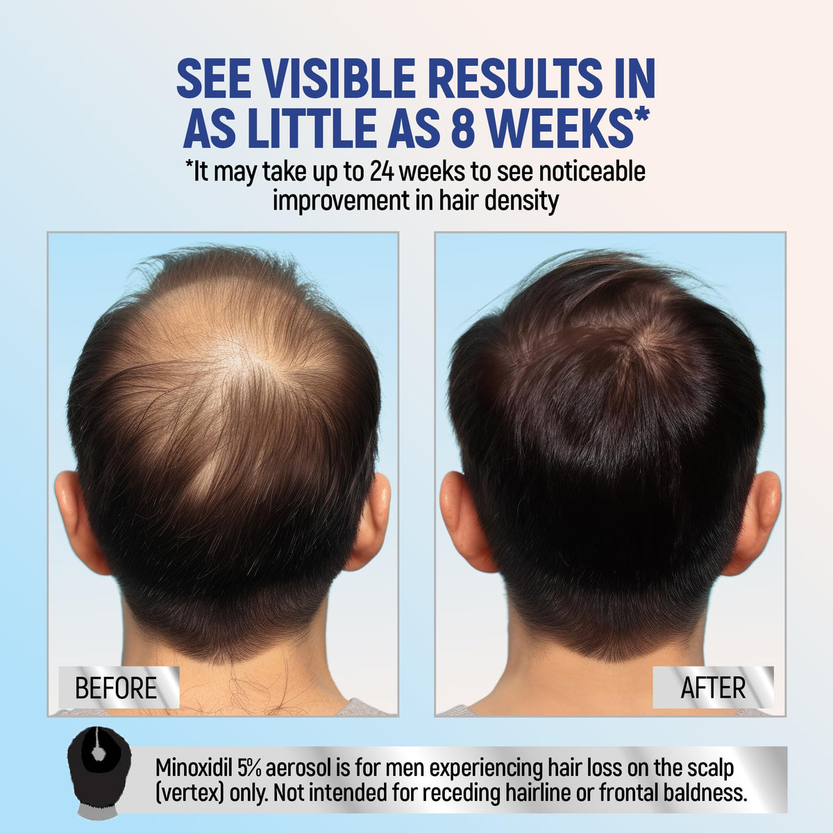 TARO Minoxidil 5% Foam side view with dosage instructions