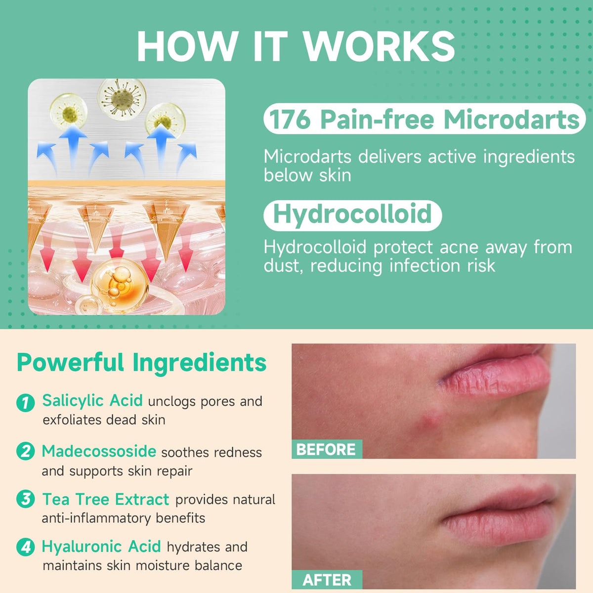 TEAWOO Microdart Pimple Patches with ingredients list