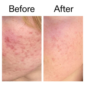 The INKEY List Azelaic Acid Serum close-up of bottle