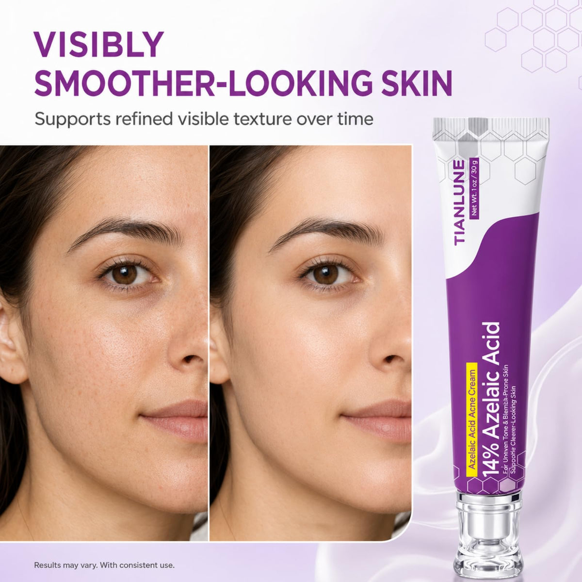 TIANLUNE Azelaic Acid 14% Cream application on skin