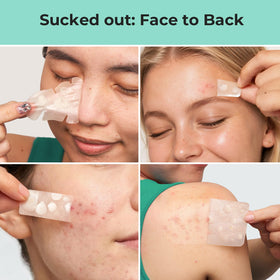 TKTK Large Hydrocolloid Pimple Patches on a bathroom counter