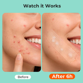 TKTK Large Hydrocolloid Pimple Patches with individual packaging