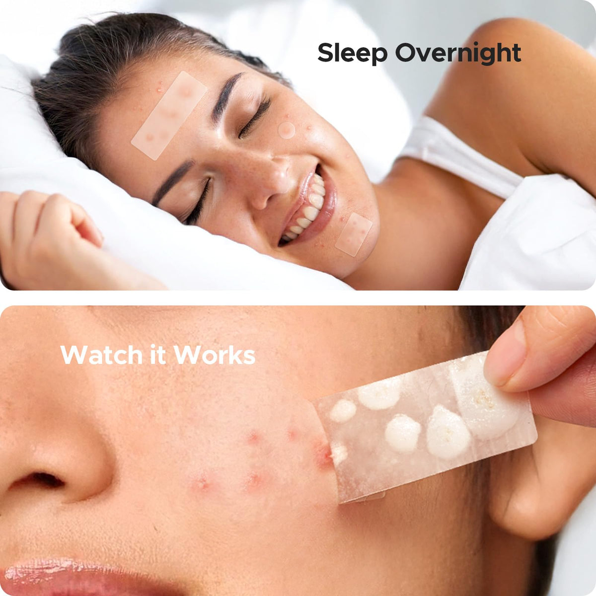 TKTK Pimple Patches in use on forehead
