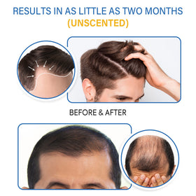 TOMUM 5% Minoxidil Foam with a clean scalp application