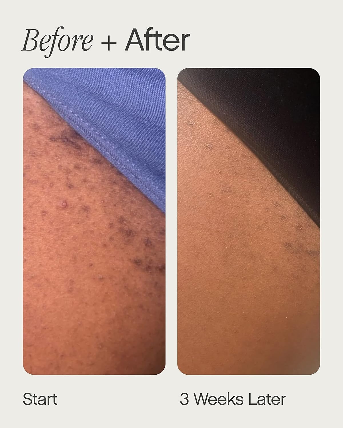 Topicals High Roller Ingrown Hair Serum back view with ingredient list