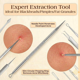 Travel case for DERMATED 6 Pcs Pimple Popper Tool Kit