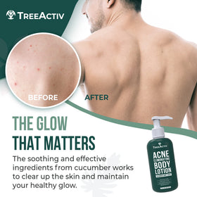 TreeActiv Acne Eliminating Body Lotion 8 fl oz back view