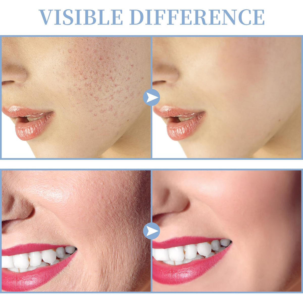 TUMAKOU High Frequency Facial Machine tongue tube detail