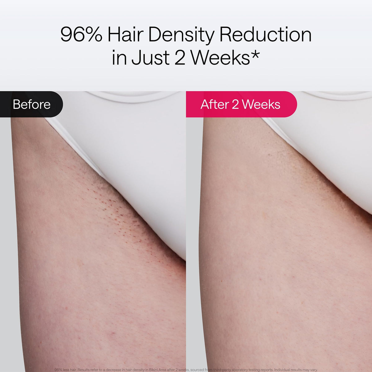 Ulike Laser Hair Removal Air 10 Deluxe device with sapphire ice-cooling feature