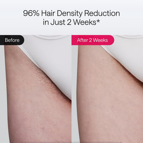 Ulike Laser Hair Removal Air 10 Deluxe device with sapphire ice-cooling feature
