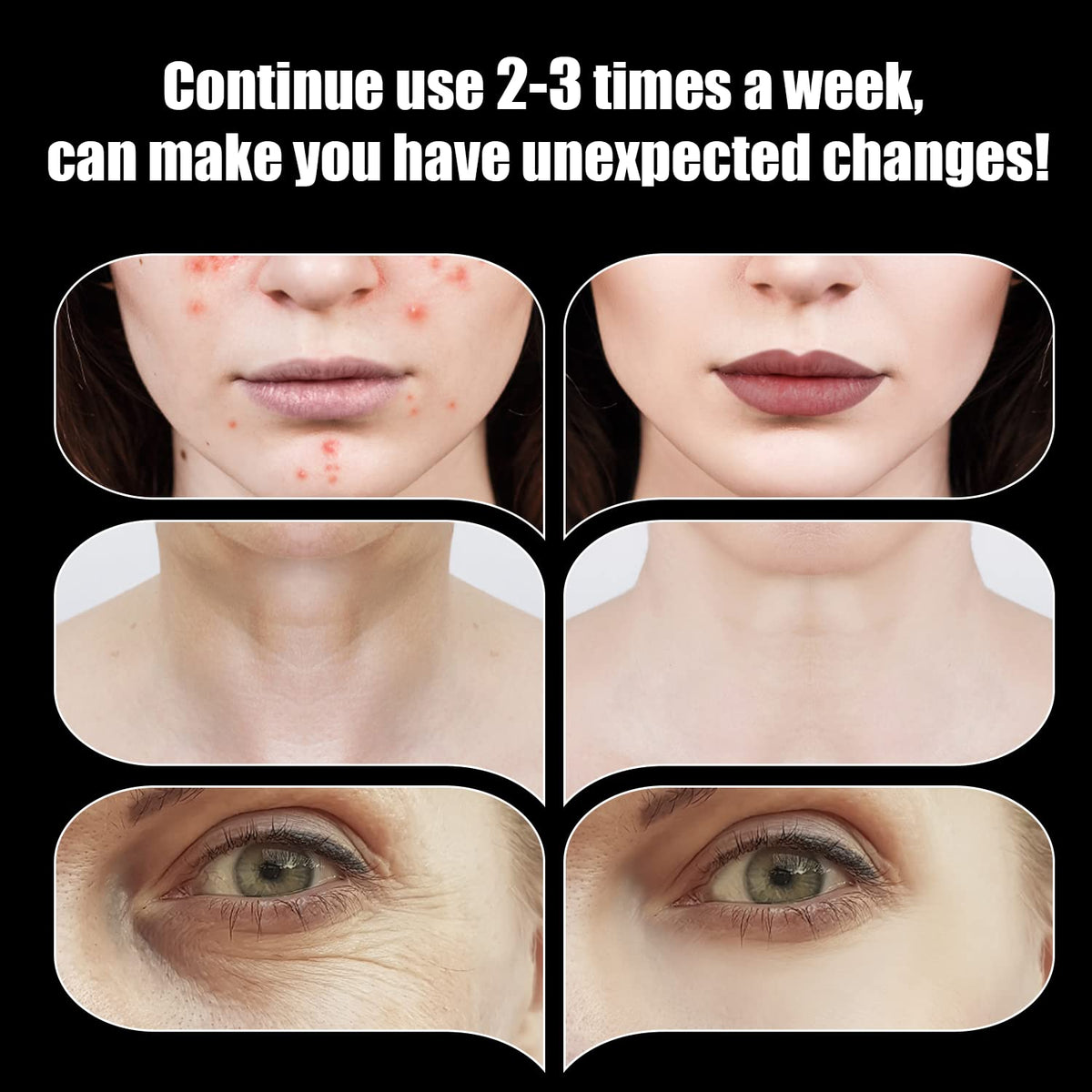 UUPAS High Frequency Facial Wand with tungsten tube