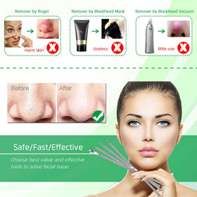 UWOIST stainless steel blackhead extractor tool close-up