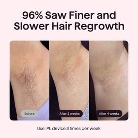 Wavytalk IPL Hair Removal Device in use on leg