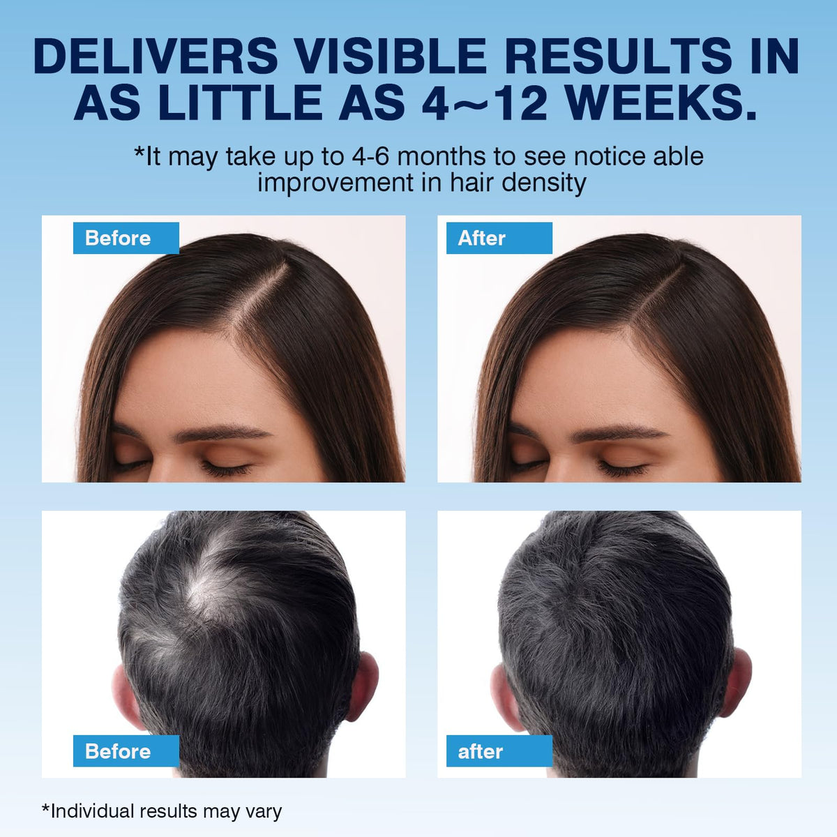 YKDYLINH Minoxidil Foam application on scalp