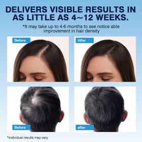 YKDYLINH Minoxidil Foam application on scalp