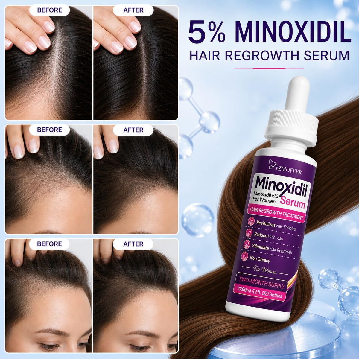 Yzmoffer Minoxidil 5% Hair Regrowth application on scalp